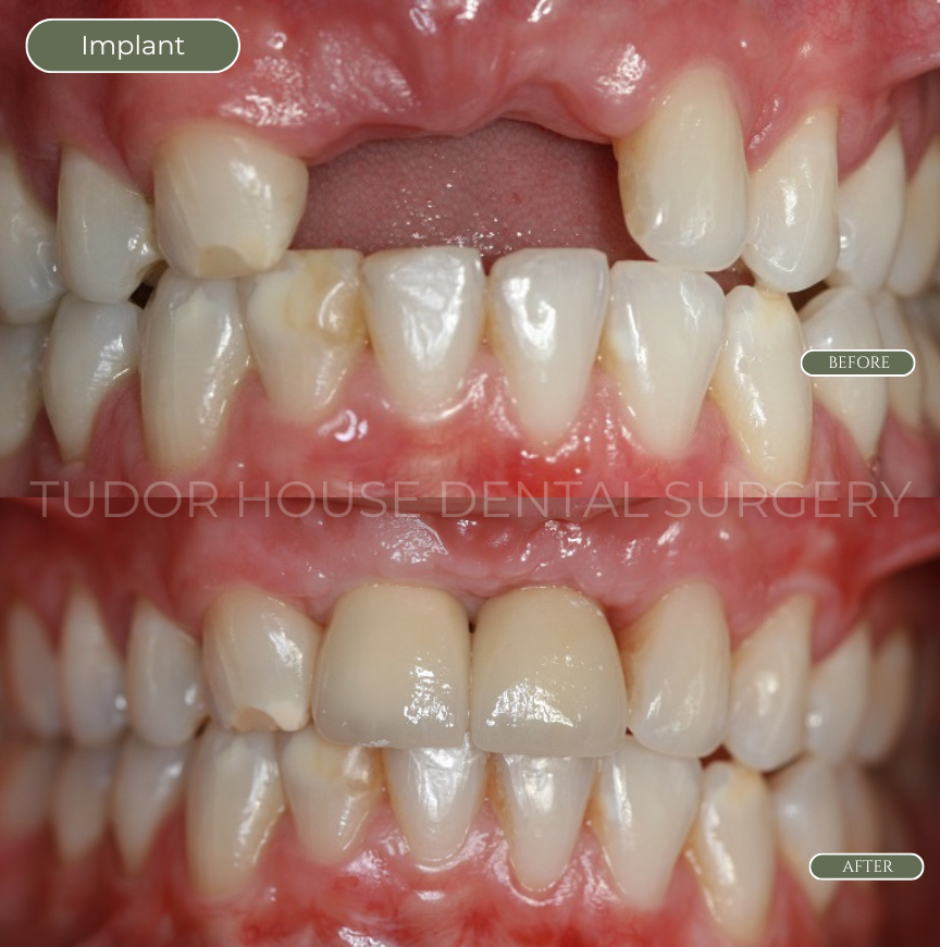 Before dental implant treatment at Tudor House Dental