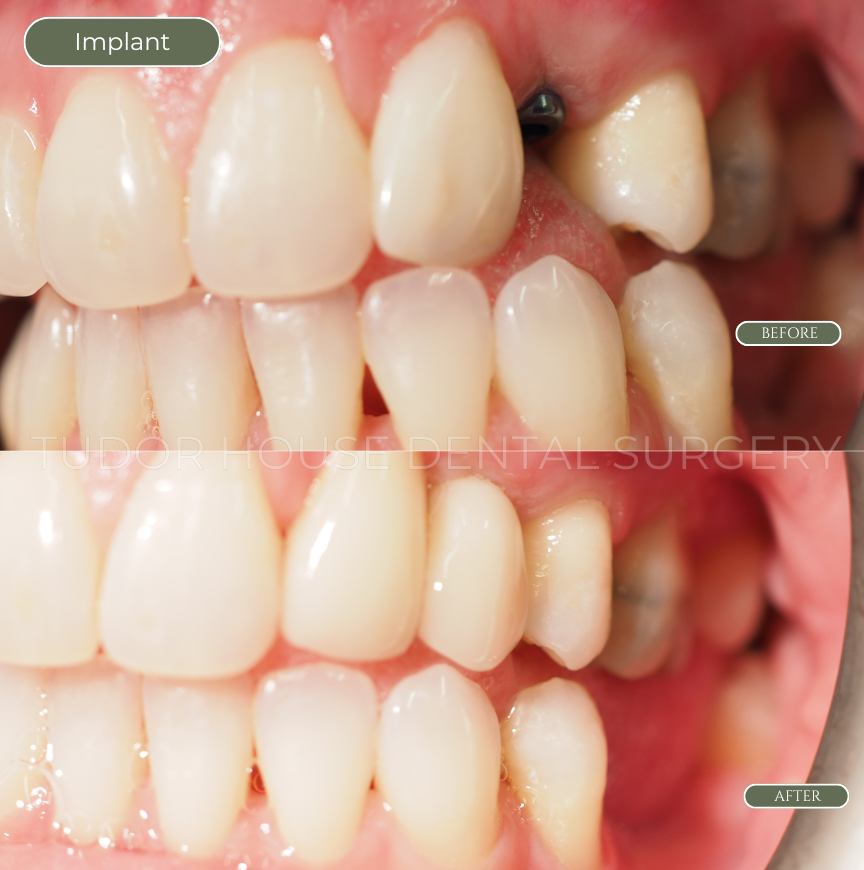 After dental implant treatment at Tudor House Dental